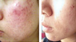 Acne Therapy