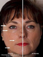 Galvanic Skin Rejuvenation results Galvanic Skin Rejuvenation treatment results