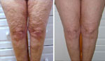 Galvanic Skin Rejuvenation results Galvanic Skin Rejuvenation treatment results