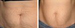 Galvanic Skin Rejuvenation results Galvanic Skin Rejuvenation treatment results