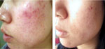 Galvanic Skin Rejuvenation results Galvanic Skin Rejuvenation treatment results
