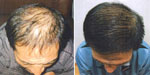 Galvanic Skin Rejuvenation results Galvanic Skin Rejuvenation treatment results