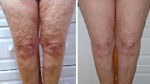 Galvanic Skin Rejuvenation
