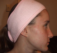 Day 1 of Galvanic Skin Rejuvenation treatment Day 1 of Galvanic Skin Rejuvenation treatment