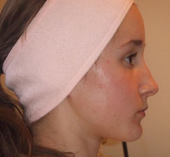 Day 21 of Galvanic Skin Rejuvenation treatment Day 21 of Galvanic Skin Rejuvenation treatment