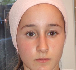 Day 28 of Galvanic Skin Rejuvenation treatment Day 28 of Galvanic Skin Rejuvenation treatment