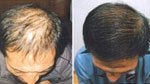 Galvanic Hair Rejuvenation
