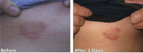 Luminesce™ before and after Luminesce™ before and after photos