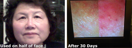 Luminesce™ before and after Luminesce™ before and after photos