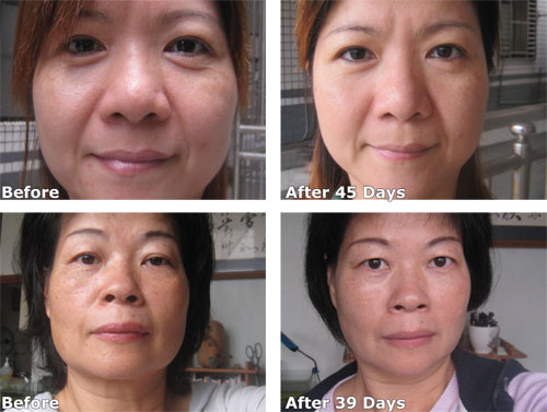 Luminesce™ before and after Luminesce™ before and after photos