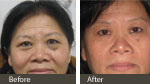 Luminesce™ Skin Rejuvenation