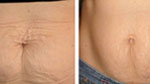 Galvanic Saggy Tummy Rejuvenation
